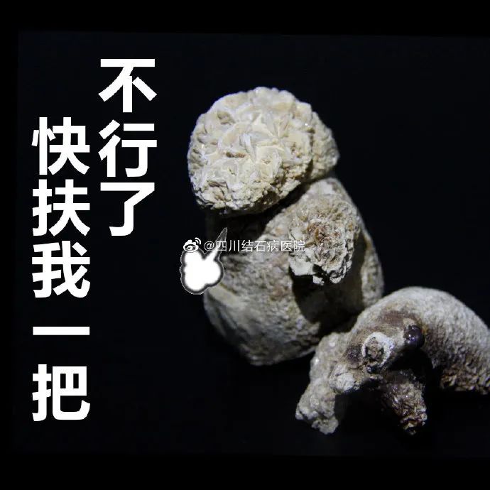 胆结石拖一拖无所谓？四川保胆取石专家：那是你没见识到它的“杀伤力”(图3)