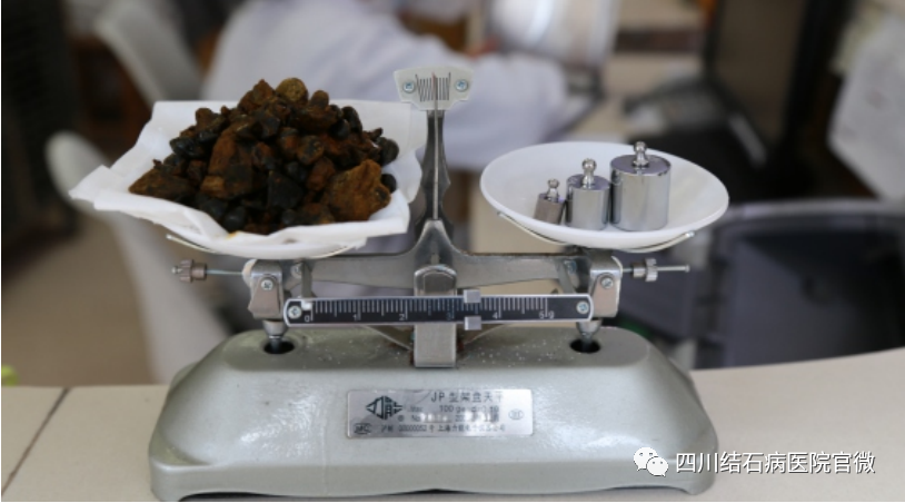 胆结石拖一拖无所谓？四川保胆取石专家：那是你没见识到它的“杀伤力”(图4)