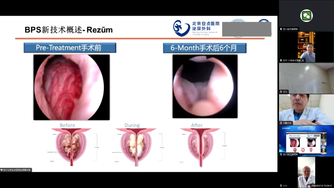 四川结石病医院召开瑞梦前列腺热蒸汽消融手术完成100例学术报告会(图11)