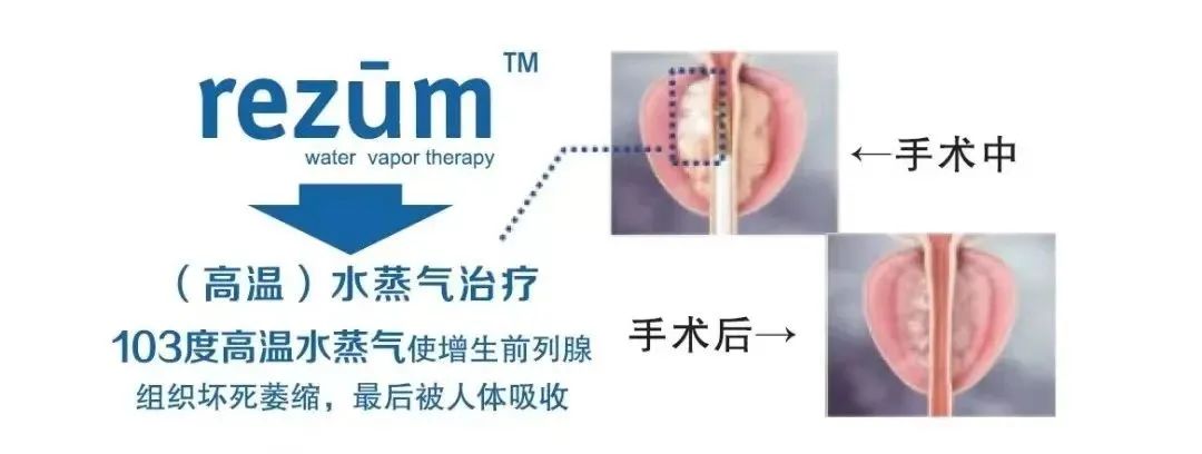 四川瑞梦热蒸汽消融技术：6分钟解决甘肃患者4年前列腺增生困扰(图8)