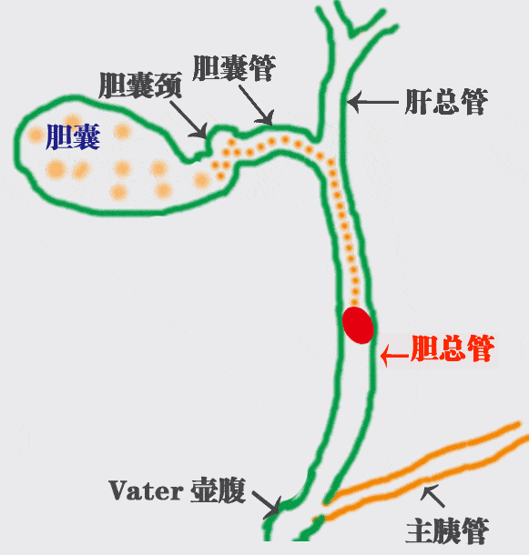 害怕手术、想吃药的胆结石病友，来看看这个患者的亲身经历「成都胆结石医院」(图3)
