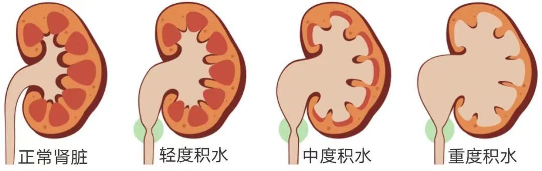 警惕！肾结石平时没啥感觉，一查发现竟充满整个肾脏！【成都结石病医院 | 成都肾结石医院】(图8)
