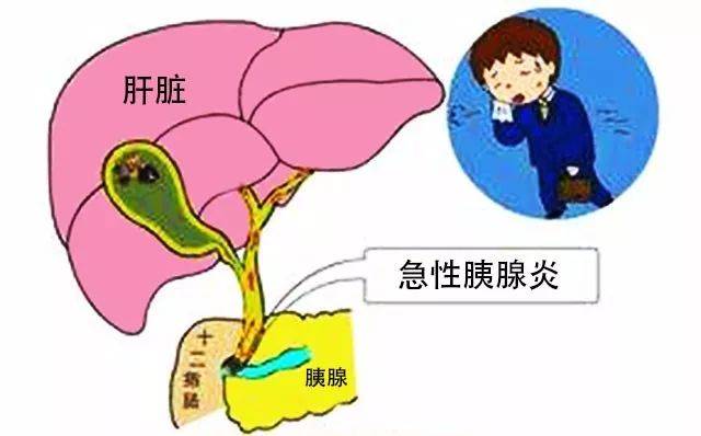 胆结石可以不管吗？四川胆结石医院专家提醒：当心小毛病拖成癌！(图2)