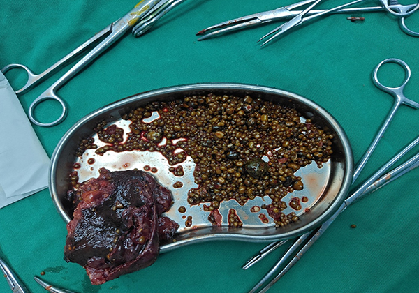 都江堰患者胆囊惊现1343颗结石 拖延治疗致胆囊坏疽【四川胆结石专科医院】(图4)