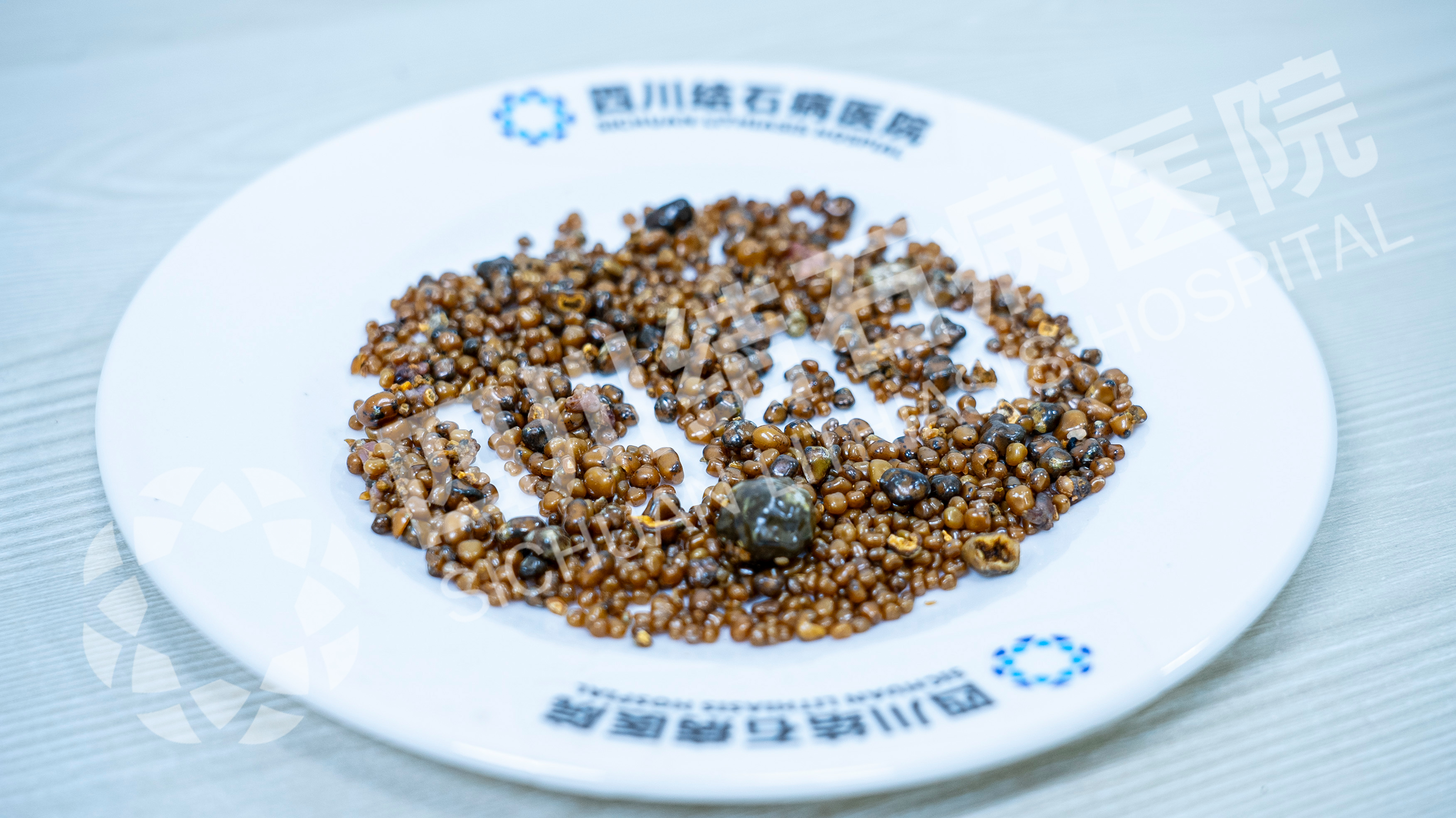 都江堰患者胆囊惊现1343颗结石 拖延治疗致胆囊坏疽【四川胆结石专科医院】(图1)