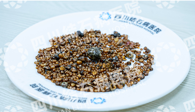 都江堰患者胆囊惊现1343颗结石 拖延治疗致胆囊坏疽【四川胆结石专科医院】(图2)