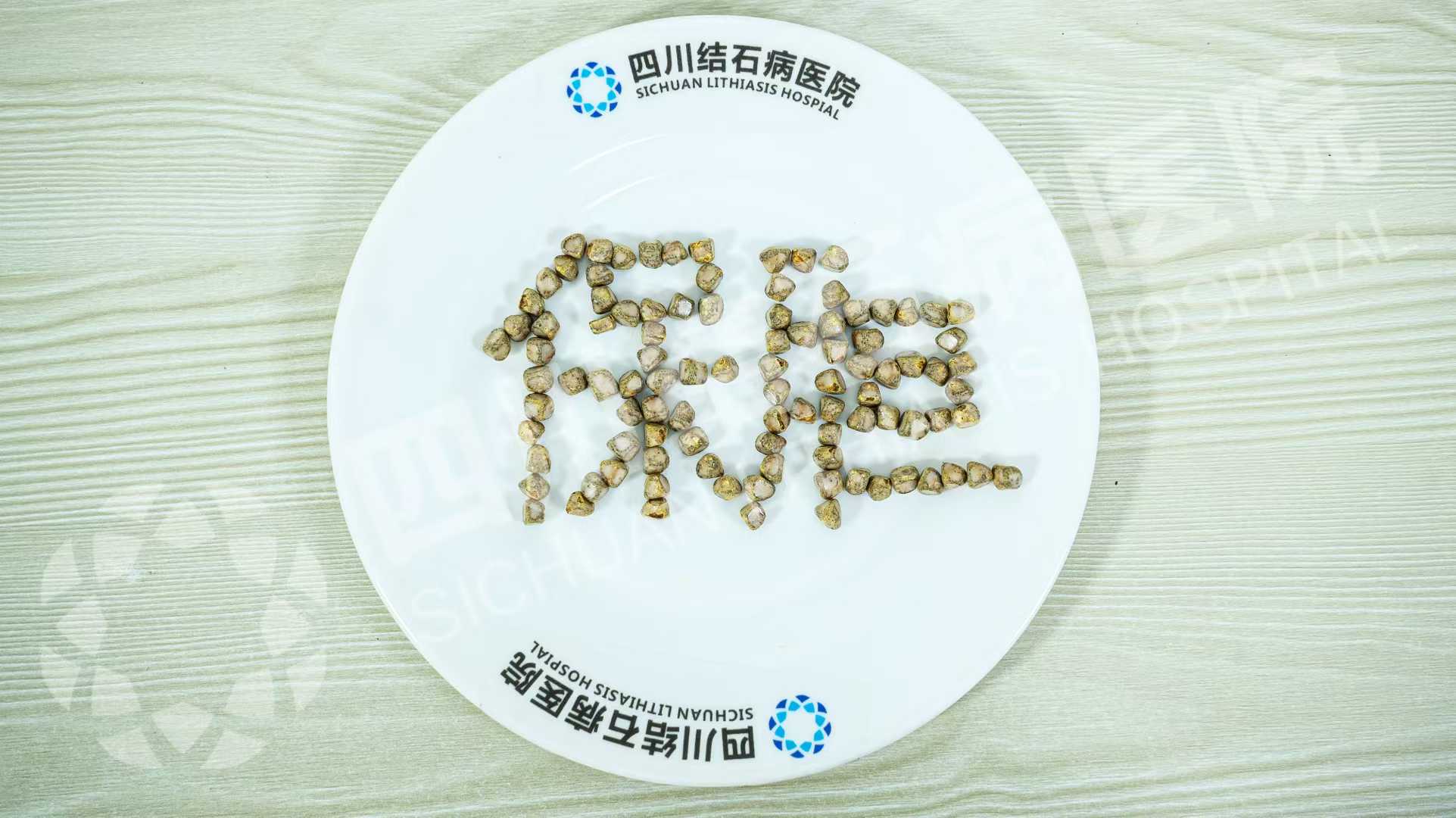 五天三例！四川结石病医院接连取出126颗、275颗、1343颗结石(图1)