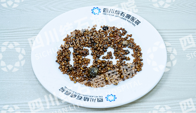 五天三例！四川结石病医院接连取出126颗、275颗、1343颗结石(图3)