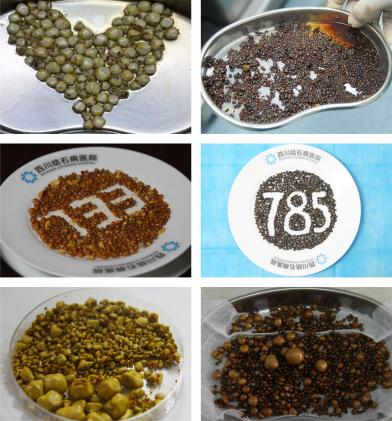 五天三例！四川结石病医院接连取出126颗、275颗、1343颗结石(图6)