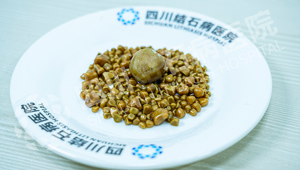 无症状≠无风险！40岁女子突发腹痛，四川结石病医院保胆取出275颗结石(图1)