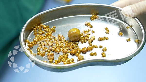 无症状≠无风险！40岁女子突发腹痛，四川结石病医院保胆取出275颗结石(图2)