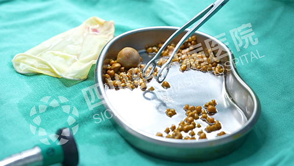 无症状≠无风险！40岁女子突发腹痛，四川结石病医院保胆取出275颗结石(图4)