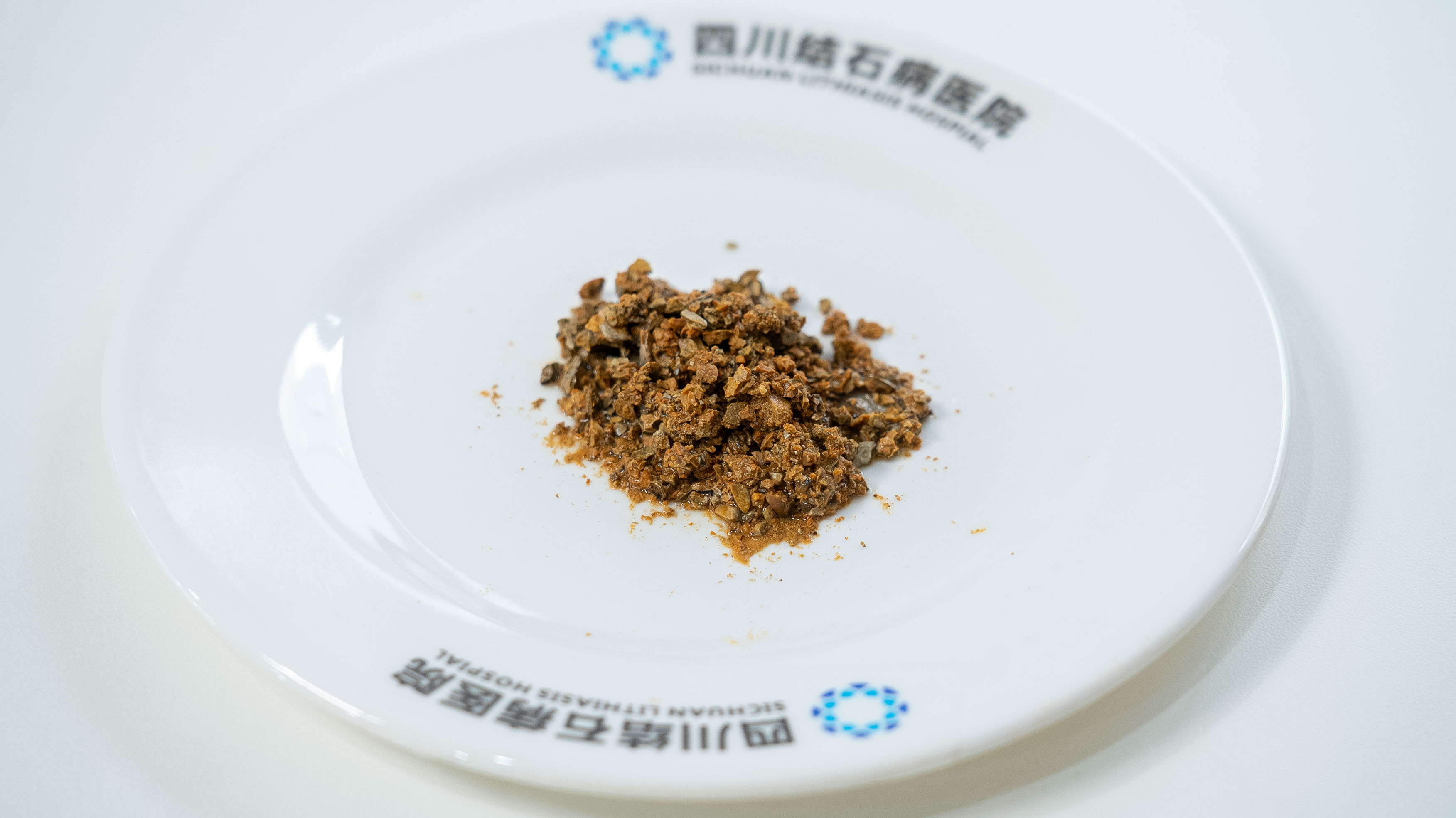 胆结石患者注意！这3个关键时机一错过，胆囊可能就保不住了【四川胆结石专科医院】(图3)
