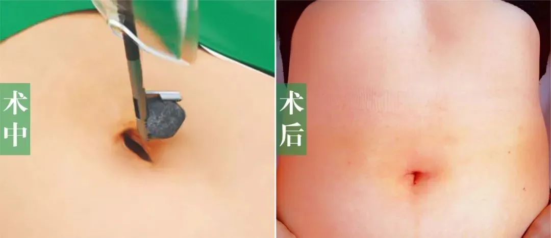 警惕!结石长期不重视可能癌变,这2个高危饮食习惯赶紧改【四川胆结石专科医院】(图4) 警惕!结石长期不重视可能癌变,这2个高危饮食习惯赶紧改【四川胆结石专科医院】(图4)