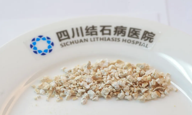 常立高教授警告：体外碎石有严格禁忌，切勿轻信“包碎”广告(图2)