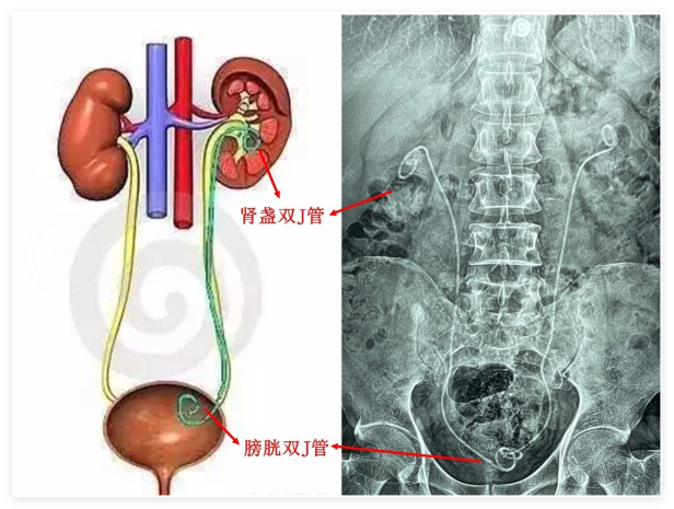 泌尿结石还能实现“舒适取石”?四川结石病医院做到了!(图3) 泌尿结石还能实现“舒适取石”?四川结石病医院做到了!(图3)