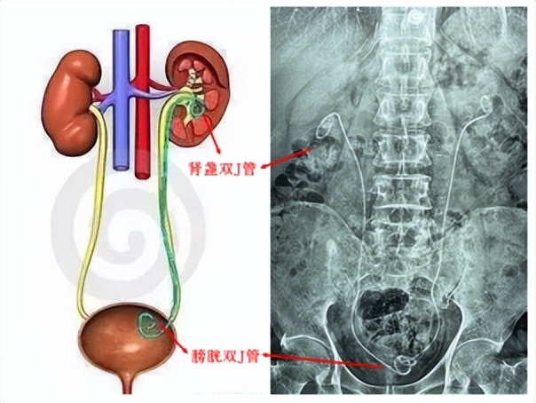 无管更自在!输尿管结石无管化技术,告别插管之苦【四川结石病医院】(图1) 无管更自在!输尿管结石无管化技术,告别插管之苦【四川结石病医院】(图1)