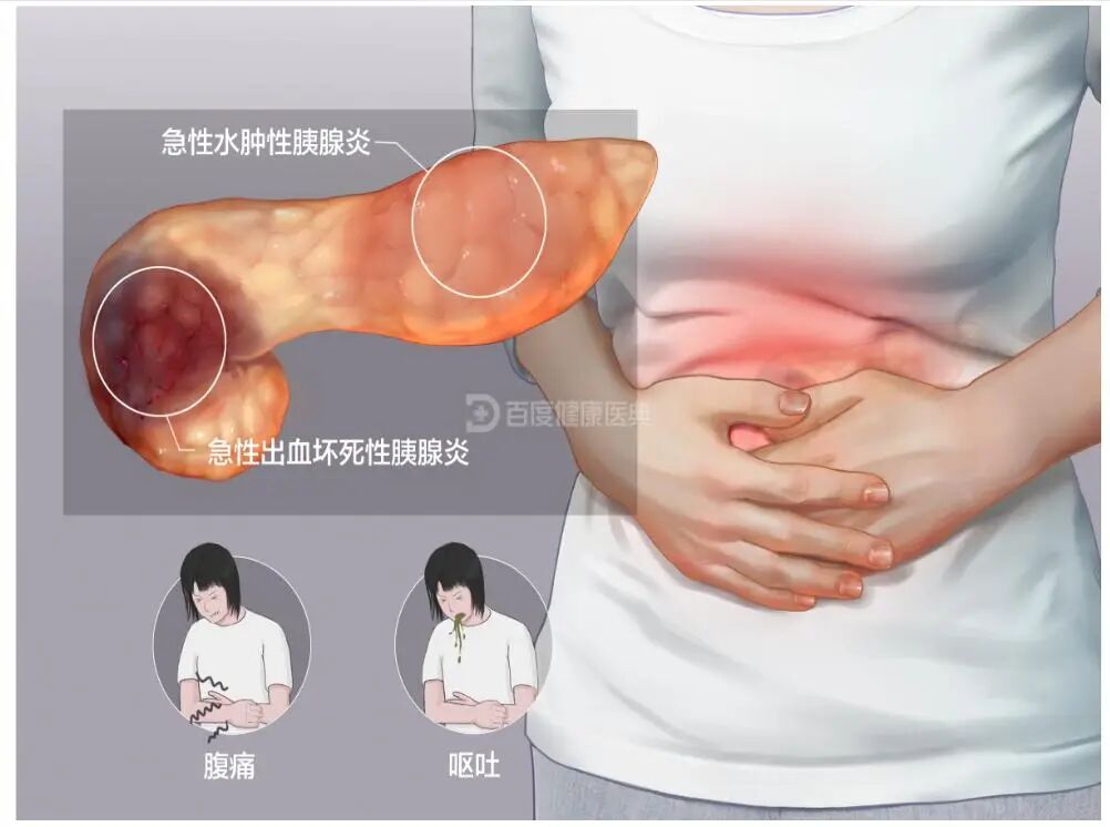 沉默的胆囊结石:不痛不痒,却可能悄悄“引爆”肝胰危机【四川结石病医院】(图3) 沉默的胆囊结石:不痛不痒,却可能悄悄“引爆”肝胰危机【四川结石病医院】(图3)