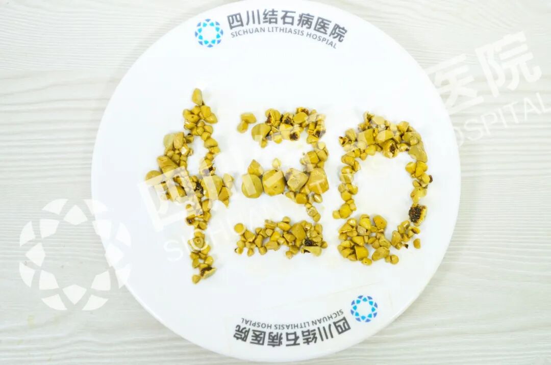 【媒体报道】四川结石病医院保胆取出430颗结石！专家支招，健康过年(图2)