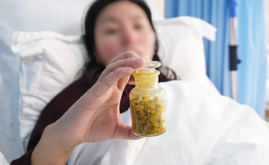 【媒体报道】四川结石病医院保胆取出430颗结石！专家支招，健康过年(图3)