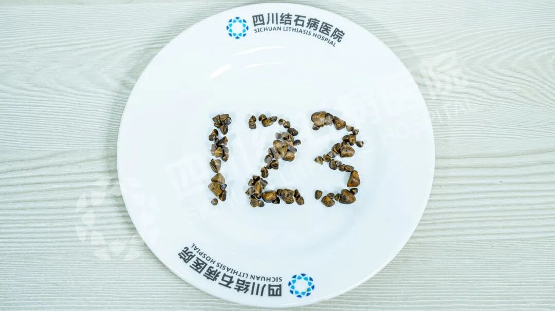 保胆取出123颗！盲目吃药为何成结石“帮凶”？【四川胆结石医院】(图1)