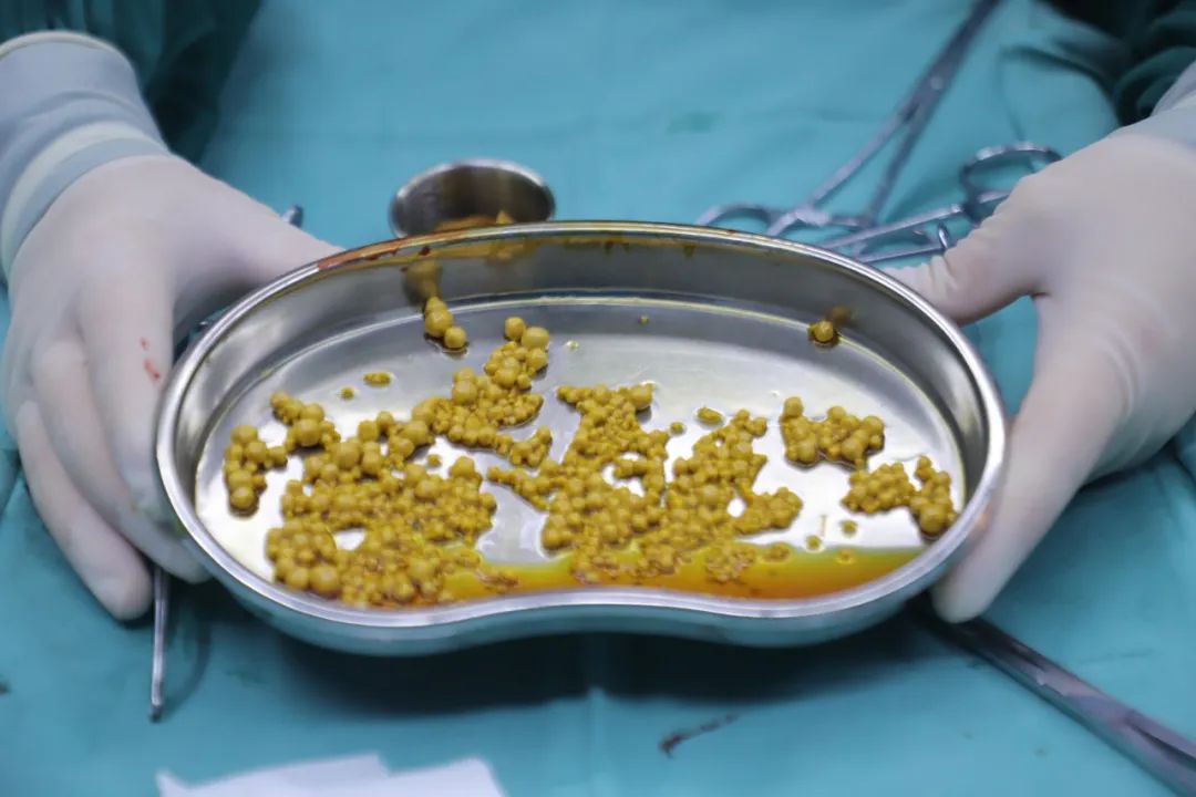 胆结石不痛,为啥还要手术?背后真相很多人不知道 | 四川结石病医院(图2) 胆结石不痛,为啥还要手术?背后真相很多人不知道 | 四川结石病医院(图2)