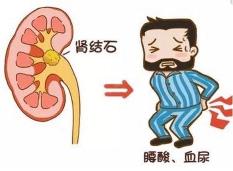 泌尿结石突然发作，该如何“自救”？｜四川结石病医院(图1)