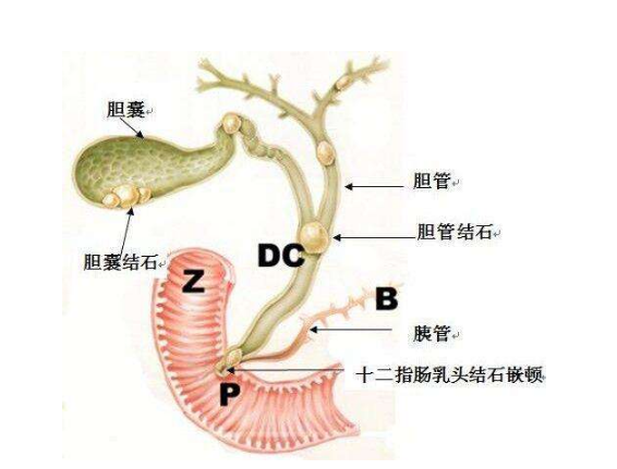 患了胆囊结石，吃药可以化掉吗？来听听肝胆科主任怎么说！(图2)