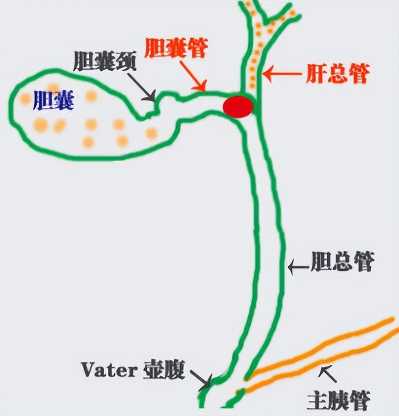 患了胆囊结石，吃药可以化掉吗？来听听肝胆科主任怎么说！(图4)