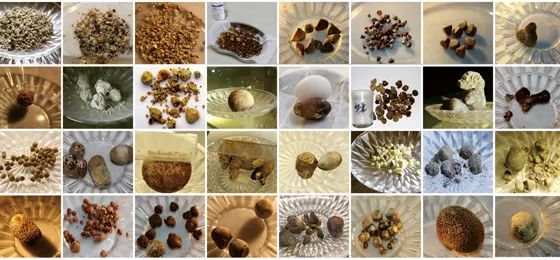 胆囊结石科学处理指南：无症状期，为什么首推“保胆取石”?(图3)