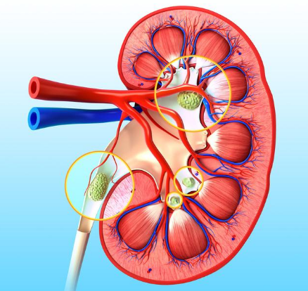 跳一跳就能排肾结石？别盲目跟风！这4种情况乱跳很要命(图3)