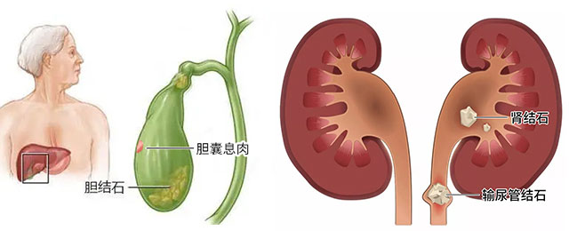 这些症状出现，你有可能患上结石病了，赶紧来自查！【四川结石病医院】(图1)
