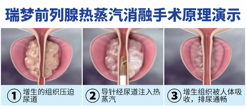 排尿难、起夜多？瑞梦热蒸汽消融术：3~5分钟微创解“男”题(图4)