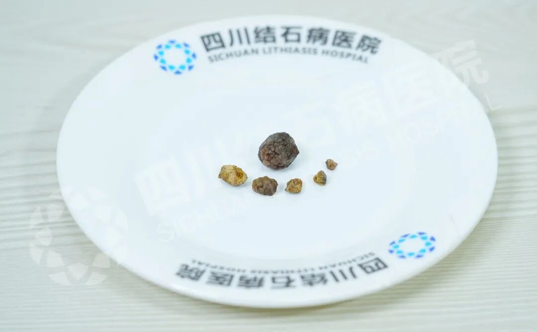 跨越千里的信任:甘肃30岁小伙的“保胆”之路【四川保胆取石医院】(图1) 跨越千里的信任:甘肃30岁小伙的“保胆”之路【四川保胆取石医院】(图1)