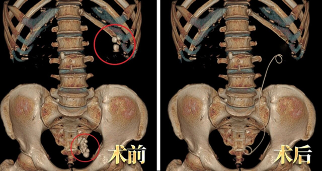 吓人!输尿管竟成“结石窝”!如何端掉这个“老巢”?【成都保肾取石医院】(图1) 吓人!输尿管竟成“结石窝”!如何端掉这个“老巢”?【成都保肾取石医院】(图1)