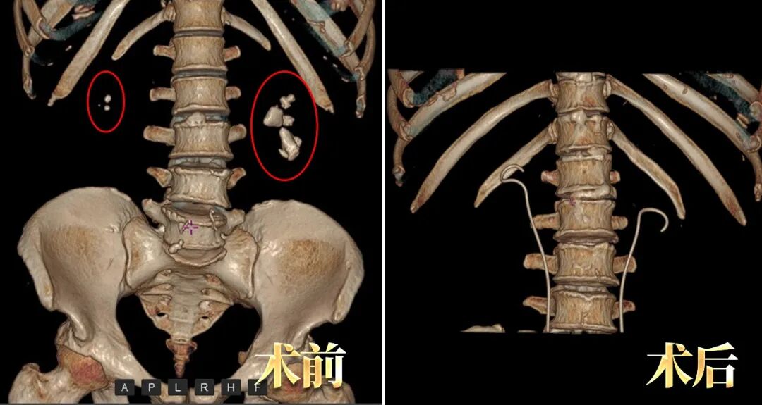 千字感谢信背后，藏着怎样的“守护肾脏”的故事【四川结石病医院】(图4)