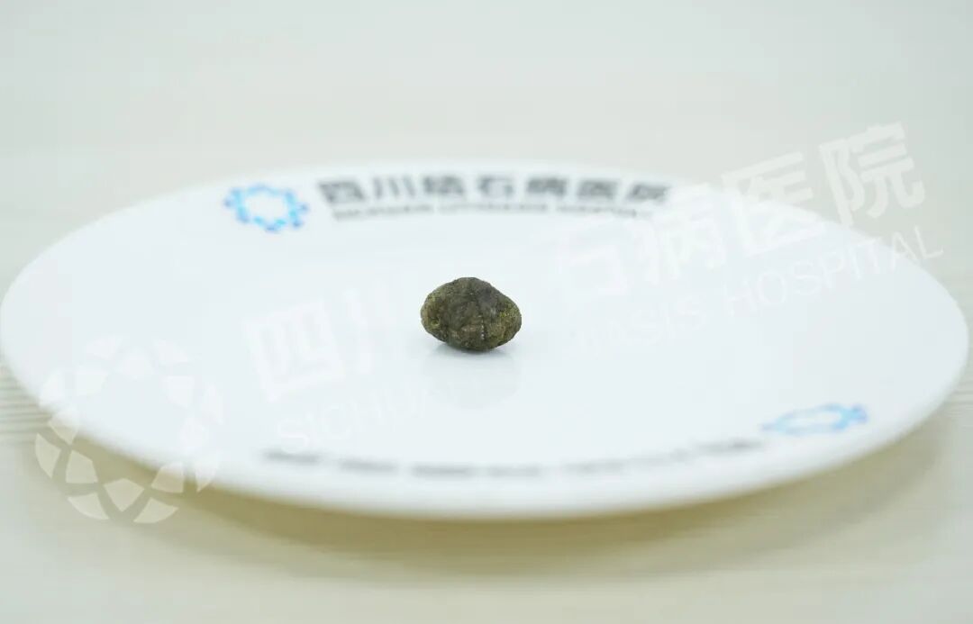 从西藏到成都，一场亲戚间的“保胆”接力【四川保胆取石医院】(图1)