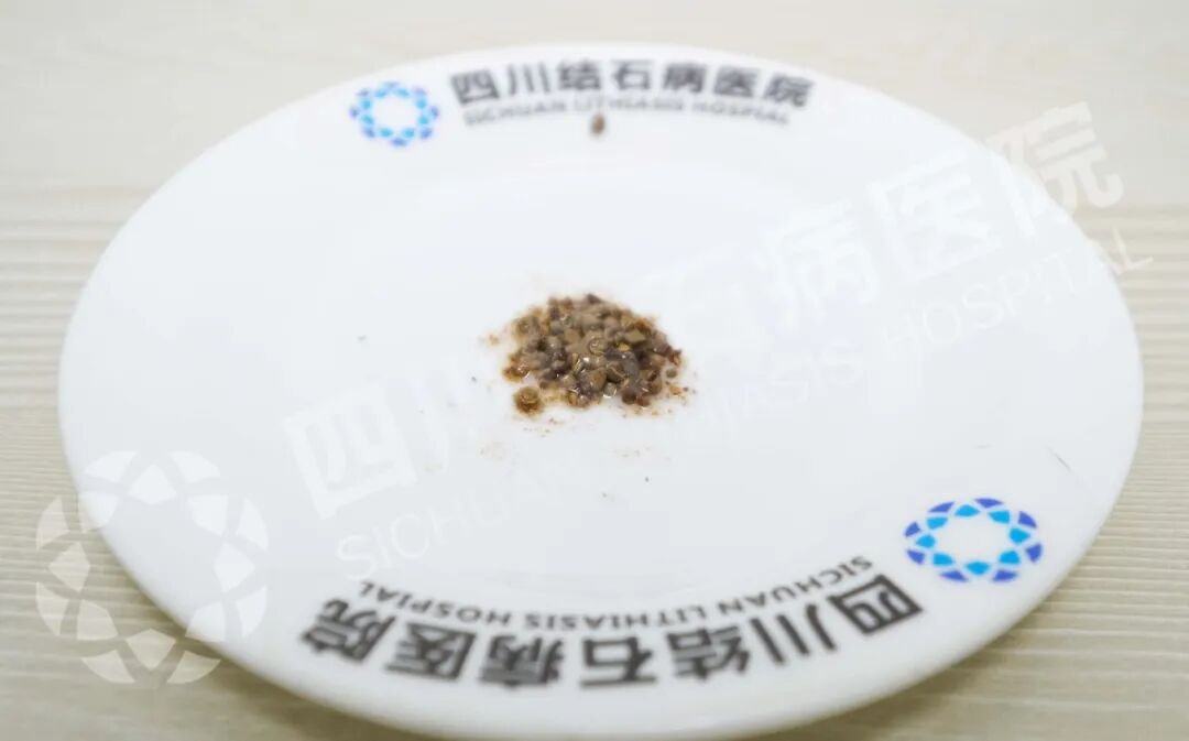 两次“体外碎石”，竟成结石“助长剂”？【四川结石病医院】(图1)