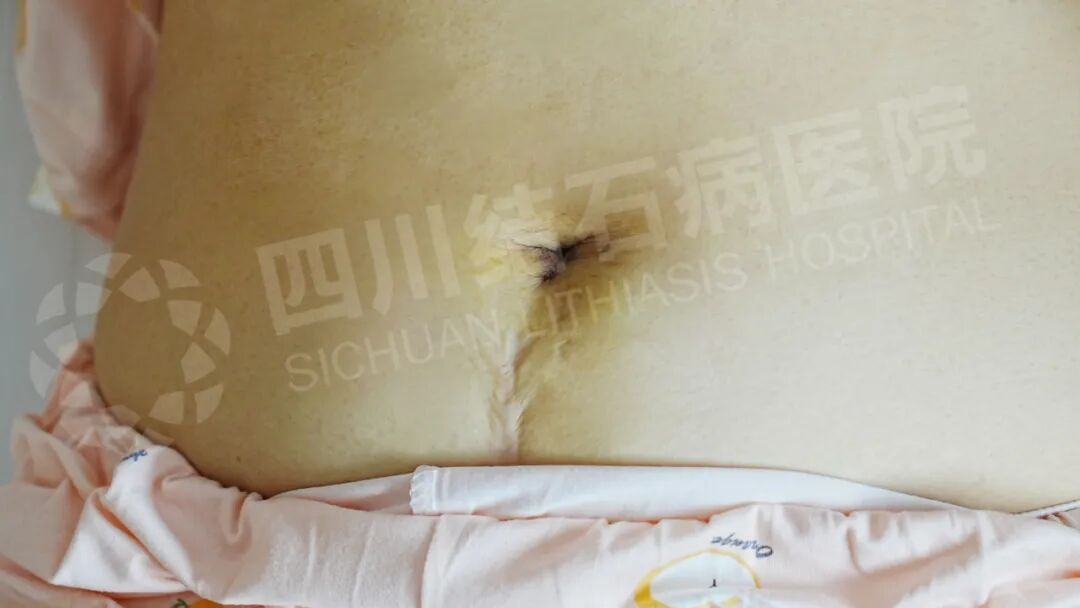 夫妻俩同样是“保胆”，为何相隔九年大不同【四川保胆取石医院】(图1)