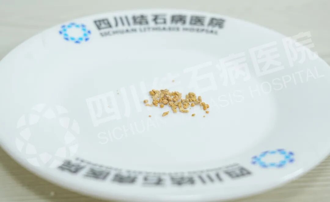 结石+多项高危因素“夹击”！79岁老人如何化险为夷【四川结石病医院】(图1)