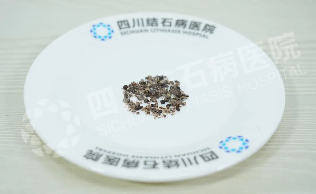 近4公分“鹿角”结石，谁说只能“打孔”取？四川肾结石医院(图2)