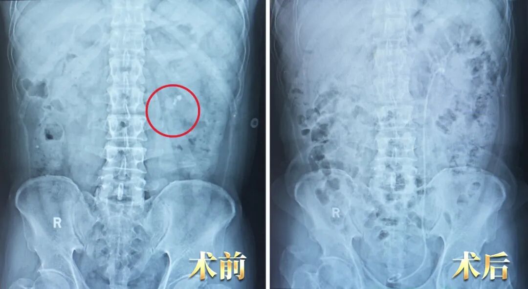 他为何十年两度托付四川结石病医院？锦旗背后藏着答案(图2)