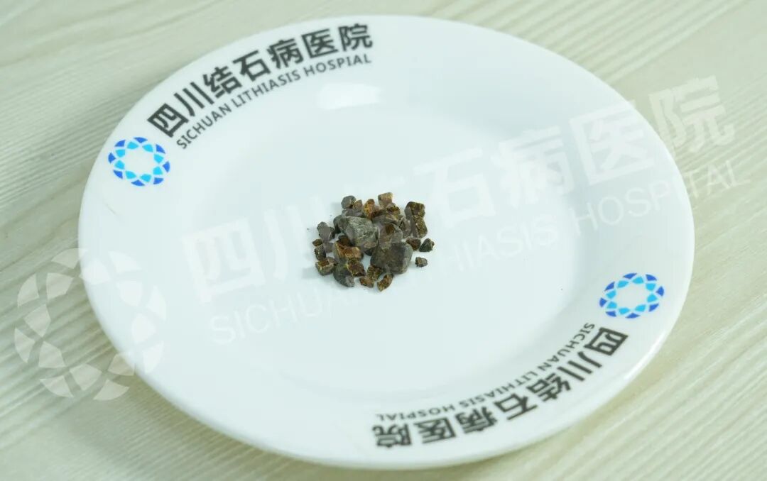 豆包指路:跨越山海!新疆患者奔赴四川结石病医院开启保胆之旅(图1) 豆包指路:跨越山海!新疆患者奔赴四川结石病医院开启保胆之旅(图1)