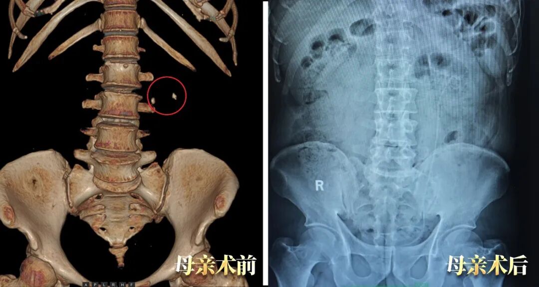 母女俩同患泌尿结石，为何坚定选择四川结石病医院？(图1)