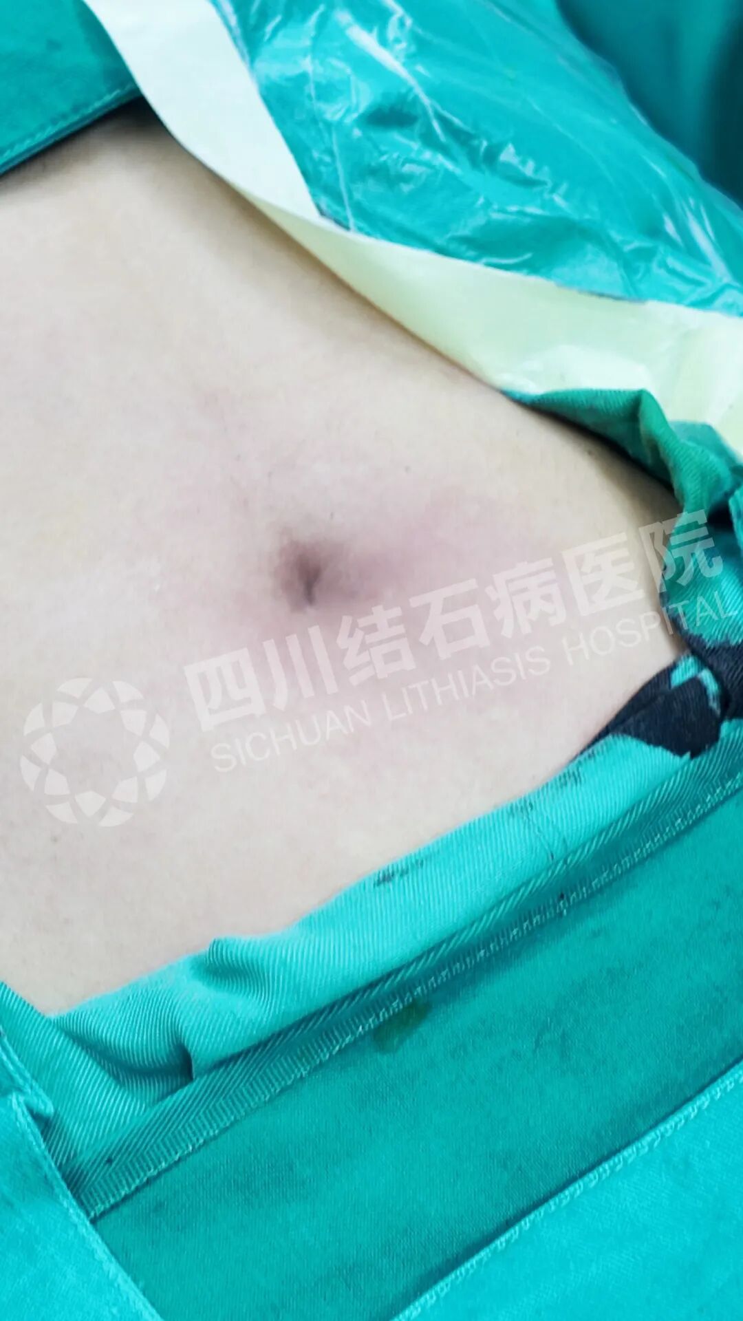 结石拦住追梦路，“隐痕保胆”为他扫清障碍【四川结石病医院】(图1)