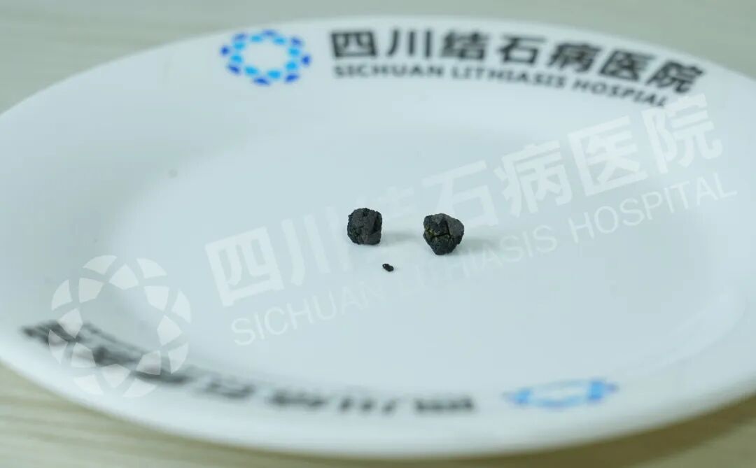 结石拦住追梦路，“隐痕保胆”为他扫清障碍【四川结石病医院】(图2)