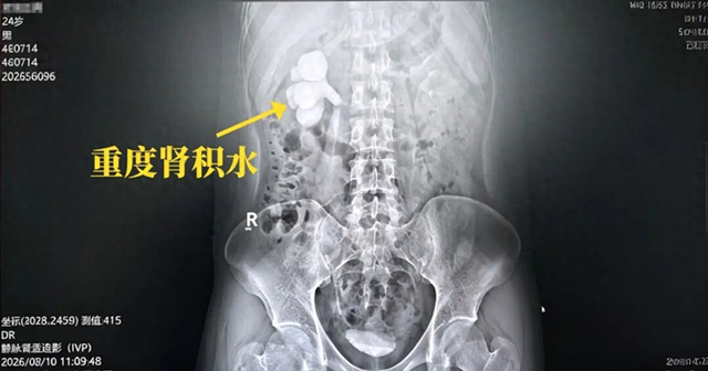 仅半年!结石发作“忍一忍”,一查肾脏差点“报废”?【四川结石病医院】(图1) 仅半年!结石发作“忍一忍”,一查肾脏差点“报废”?【四川结石病医院】(图1)