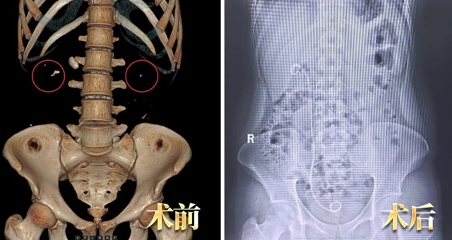 仅半年!结石发作“忍一忍”,一查肾脏差点“报废”?【四川结石病医院】(图2) 仅半年!结石发作“忍一忍”,一查肾脏差点“报废”?【四川结石病医院】(图2)