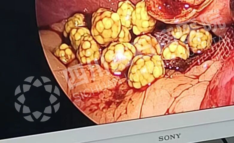 四川结石病医院提醒：胆囊内惊现“爆米花”！这些习惯你可能也有(图3)