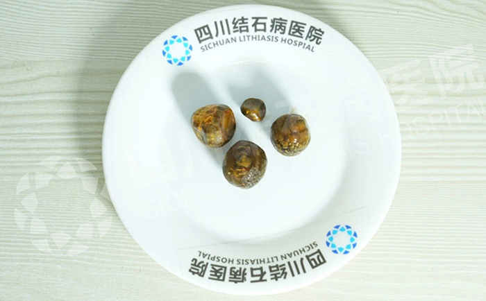 查出胆结石，为什么“早”字这么重要？四川结石病医院案例解析(图2)
